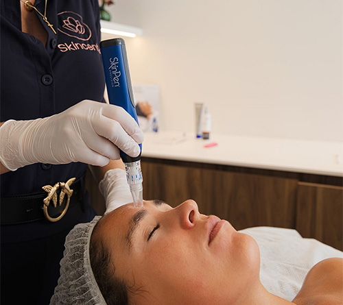 Microneedling 2