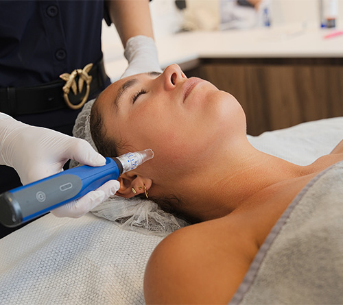 Microneedling