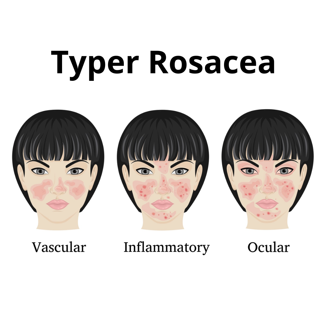 Bilde av typene med Rosacea