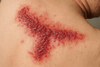 Helvetesild (Herpes Zoster): Symptomer, behandling og vaksine